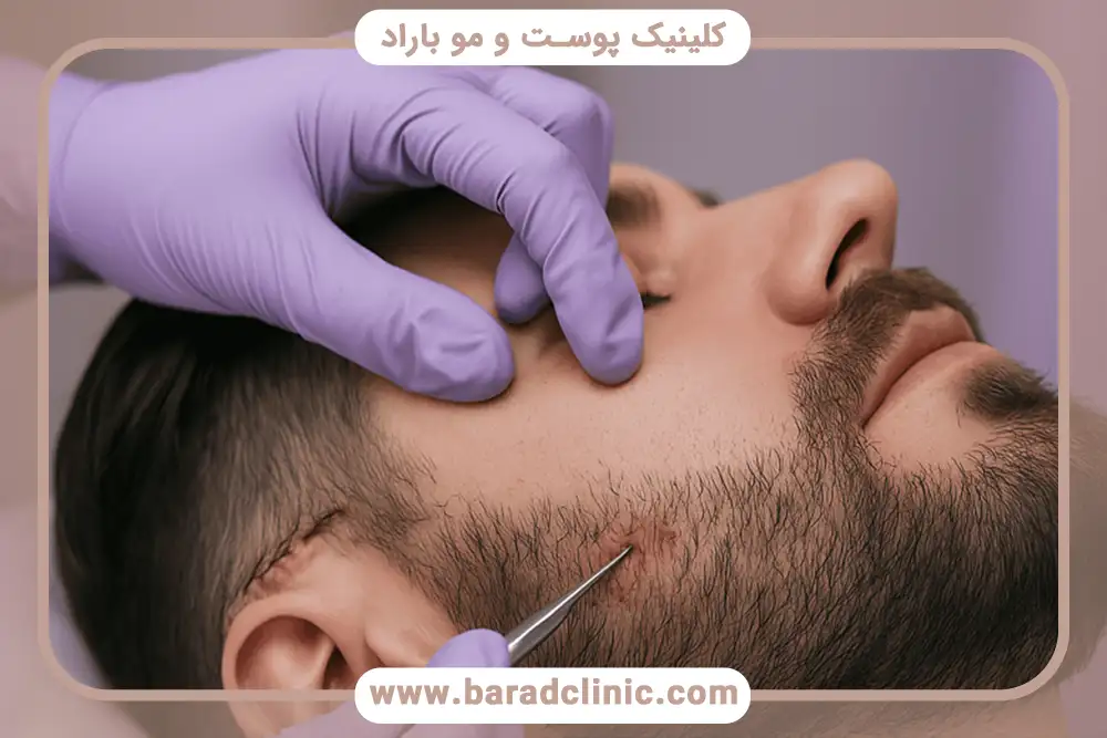 کاشت ریش چیست و چه کسانی به آن نیاز دارند؟